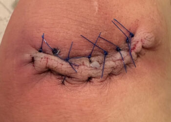 Pic: Tatiana Suarez Shares Gruesome Stitch Job After Freak Octagon-Induced Cut At UFC 312