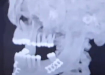 Jake Paul posts X-ray of missing teeth, titanium plates from jaw-breaking loss to Anthony Joshua