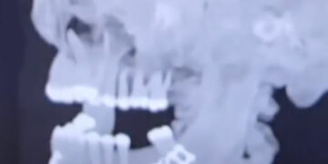 Jake Paul posts X-ray of missing teeth, titanium plates from jaw-breaking loss to Anthony Joshua